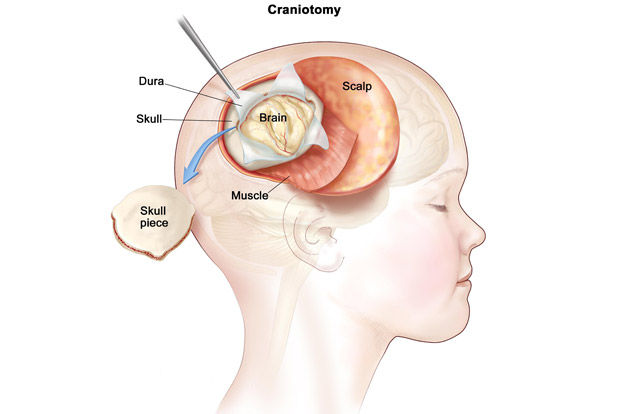 Paras Hospitals, Gurgaon, Uses the Neuronavigation Technique to Remove Brain Tumor from 7-Year-Old Kashmiri Girl